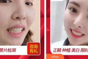 浙江大學(xué)醫(yī)學(xué)院附屬口腔醫(yī)院王慧明整形價格表附貴金屬烤瓷牙案例展示