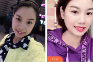 浙江大學(xué)醫(yī)學(xué)院附屬口腔醫(yī)院傅柏平整形價格表附金屬托槽矯正案例展示