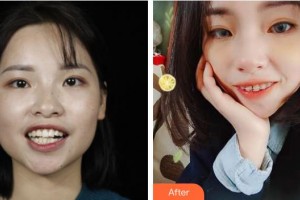 浙江大學(xué)醫(yī)學(xué)院附屬口腔醫(yī)院謝志堅整形價格表附金屬托槽矯正案例展示