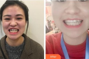 浙江大學(xué)醫(yī)學(xué)院附屬口腔醫(yī)院胡濟(jì)安整形價格表附牙齒隱形矯正案例展示