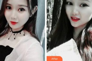 浙江大學(xué)醫(yī)學(xué)院附屬口腔醫(yī)院程志鵬整形價格表附牙齒隱形矯正案例展示