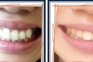 浙江大學(xué)醫(yī)學(xué)院附屬口腔醫(yī)院劉蔚整形價(jià)格表附牙齒隱形矯正案例展示