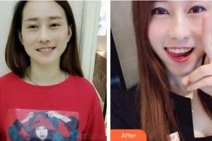 浙江大學(xué)醫(yī)學(xué)院附屬口腔醫(yī)院李曉軍整形價(jià)格表附牙齒隱形矯正案例展示