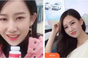 浙江大學(xué)醫(yī)學(xué)院附屬口腔醫(yī)院王朝陽(yáng)整形價(jià)格表附牙齒隱形矯正案例展示