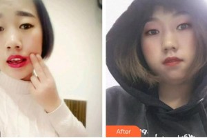 浙江大學(xué)醫(yī)學(xué)院附屬口腔醫(yī)院江巧紅整形價(jià)格表附牙齒根管調(diào)節(jié)案例展示