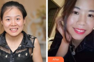 浙江大學(xué)醫(yī)學(xué)院附屬口腔醫(yī)院徐波整形價(jià)格表附自鎖托槽矯正案例展示