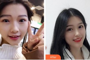 浙江大學(xué)醫(yī)學(xué)院附屬口腔醫(yī)院丁王輝整形價格表附牙齒隱形矯正案例展示