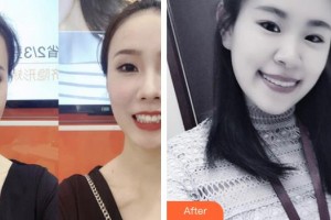 浙江大學(xué)醫(yī)學(xué)院附屬口腔醫(yī)院程俊杰整形價格表附牙齒隱形矯正案例展示