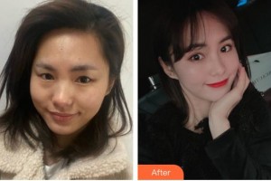 浙江省眼科醫(yī)院方愛武整形價格表附眼部整形案例展示