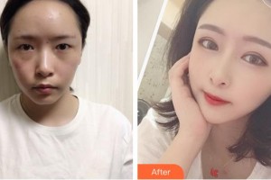 浙江省眼科醫(yī)院潘偉華整形價格表附眼部綜合案例展示