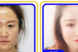 浙江大學(xué)醫(yī)學(xué)院附屬第四醫(yī)院整形美容科吳黎紅整形價格表附眼部綜合案例展示