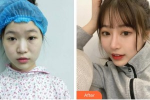 杭州整形醫(yī)院譚曉燕整形價格表附膨體隆鼻案例展示