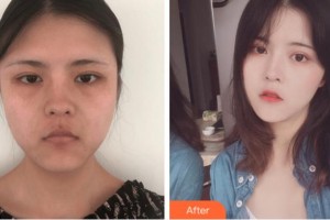 杭州整形醫(yī)院何葆華整形價格表附埋線提升案例展示