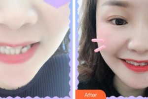 杭州時光醫(yī)療美容醫(yī)院黃錦英整形價格表附口腔矯正案例展示