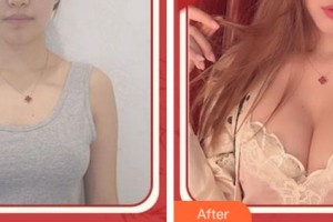 杭州華山連天美醫(yī)療美容整形醫(yī)院李超整形價格表附自體脂肪隆胸案例展示