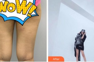 杭州新友好整形醫(yī)院韓美貞整形價格表附大腿吸脂案例展示