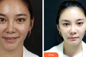 杭州瑞麗整形醫(yī)院方莉醫(yī)師整形價(jià)格表附埋線提升案例展示