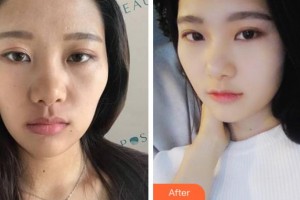 杭州瑞麗整形醫(yī)院賀激光整形醫(yī)師整形價(jià)格表附熱瑪吉案例展示