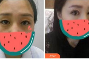 杭州東方整形外科門診部黃發(fā)明整形價(jià)格表附切開雙眼皮案例展示