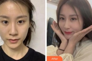 杭州麗欣醫(yī)療美醫(yī)院項(xiàng)昌峰整形價(jià)格表附切開雙眼皮案例展示