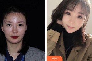 杭州麗欣醫(yī)療美醫(yī)院顧飚整形價(jià)格表附眼部綜合案例展示