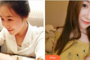 杭州珈禾整形美容醫(yī)院管嵐整形價(jià)格表附熱瑪吉案例展示