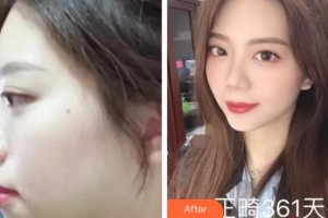 杭州珈禾整形美容醫(yī)院馮應(yīng)宏整形價(jià)格表附金屬托槽矯正案例展示