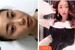 杭州新生毛發(fā)種植研究院曾令國整形價(jià)格表附種植發(fā)際線案例展示