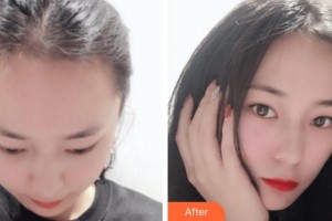 杭州新生毛發(fā)種植研究院黃云整形價(jià)格表附種植發(fā)際線案例展示