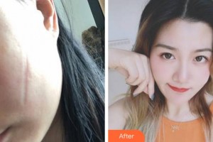 杭州格萊美整形美容醫(yī)院吳枝香整形價(jià)格表附激光祛疤案例展示