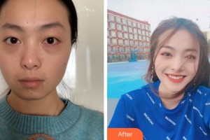 杭州格萊美整形美容醫(yī)院徐云喜整形價(jià)格表附白瓷娃娃案例展示