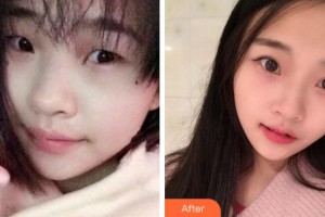 杭州瑞麗整形醫(yī)院徐少駿整形價(jià)格表附切開雙眼皮案例展示