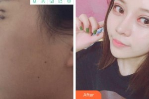 杭州維多利亞醫(yī)療美容醫(yī)院袁宇鋼整形價(jià)格表附眼部綜合案例展示