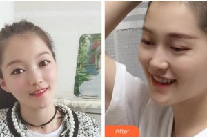 杭州時(shí)光醫(yī)療美容醫(yī)院茅來發(fā)整形價(jià)格表附金屬托槽矯正案例展示