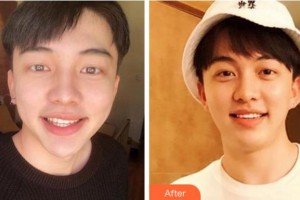 杭州華山連天美醫(yī)療美容整形醫(yī)院顧閱整形價(jià)格表附美白貼片案例展示