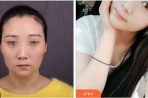 杭州華山連天美醫(yī)療美容整形醫(yī)院金圣浩整形價(jià)格表附埋線提升案例展示