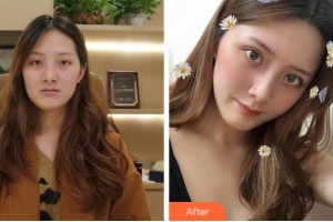 杭州整形醫(yī)院徐彬整形價(jià)格表附切開雙眼皮案例展示