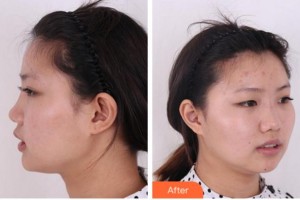 杭州整形醫(yī)院施嫣彥整形價(jià)格表附鼻部綜合案例展示