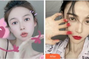 杭州整形醫(yī)院沈劍整形價(jià)格表附耳軟骨復(fù)合隆鼻案例展示