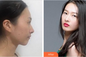 杭州靜港醫(yī)療美容診所林忠泵整形價(jià)格表附鼻部綜合案例展示