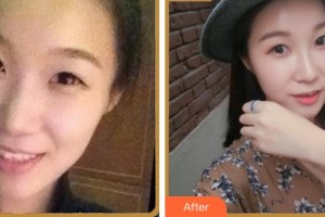 杭州整形醫(yī)院鄭群整形價(jià)格表附熱瑪吉案例展示