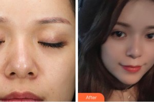 杭州東方整形外科門診部萬夢華整形價(jià)格表附熱拉提案例展示