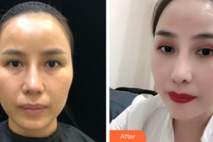 杭州啟美醫(yī)療美容醫(yī)院梁浩銘整形價(jià)格表附熱拉提案例展示