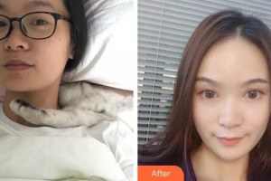 杭州啟美醫(yī)療美容醫(yī)院武安善整形價(jià)格表附熱瑪吉案例展示