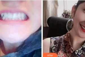 杭州市第一人民醫(yī)院醫(yī)學(xué)美容科李金晟整形價(jià)格表附牙齒陶瓷矯正案例展示