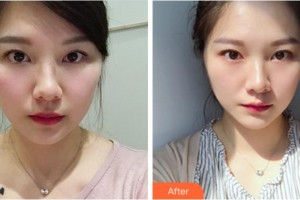 杭州藝星醫(yī)療美容醫(yī)院朱慧芳整形價(jià)格表附埋線提升案例展示