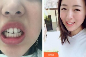 杭州藝星醫(yī)療美容醫(yī)院張鳴整形價(jià)格表附隱形托槽矯正案例展示