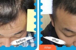 杭州科發(fā)源帝麥整形醫(yī)院閉陸祥整形價(jià)格表附植發(fā)養(yǎng)發(fā)案例展示