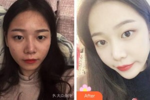 杭州維多利亞醫(yī)療美容醫(yī)院馬騰整形價(jià)格表附切開(kāi)雙眼皮案例展示