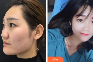 杭州維多利亞醫(yī)療美容醫(yī)院許秀珍整形價(jià)格表附抗衰老案例展示